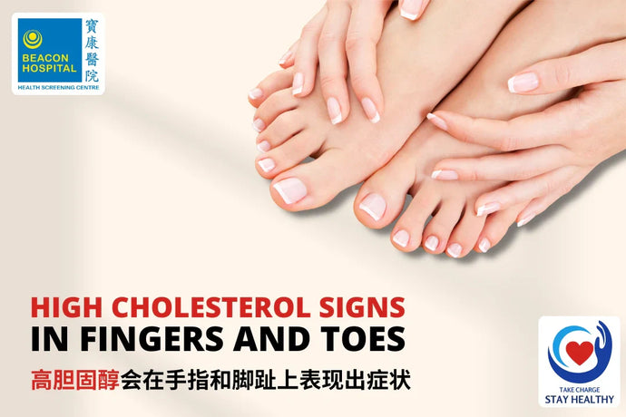 High Cholesterol Signs in Fingers and Toes